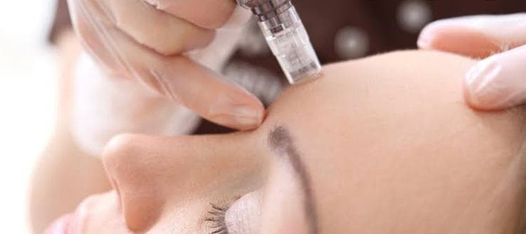 Chemical Peels vs Microneedling – Which Is Right for You?