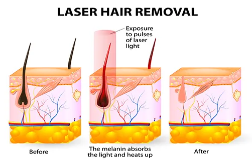 laser hair removal johannesburg